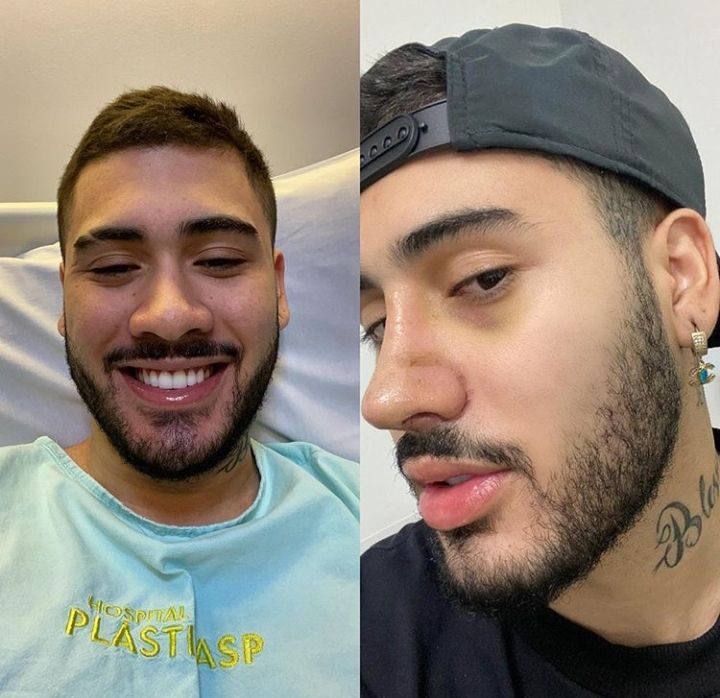 Kevinho: "Nariz, tá ok"