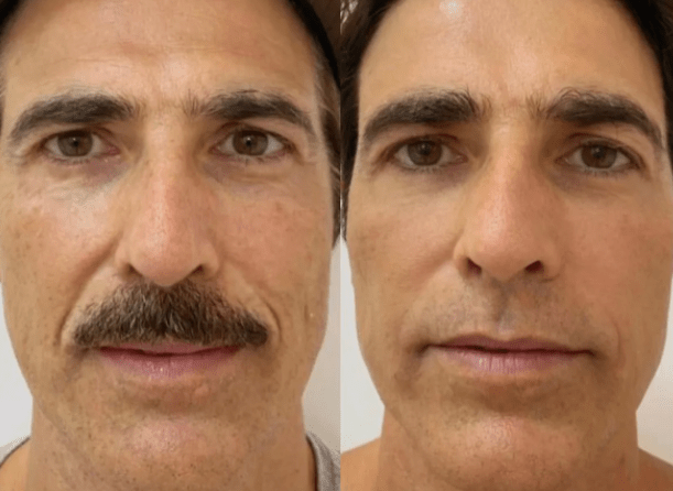 Aos 48, Reynaldo Gianecchini faz rejuvenescimento facial