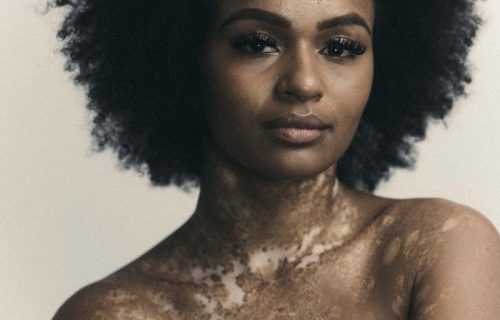 'Shed Some Light' retrata a autoaceitação do vitiligo com histórias reais