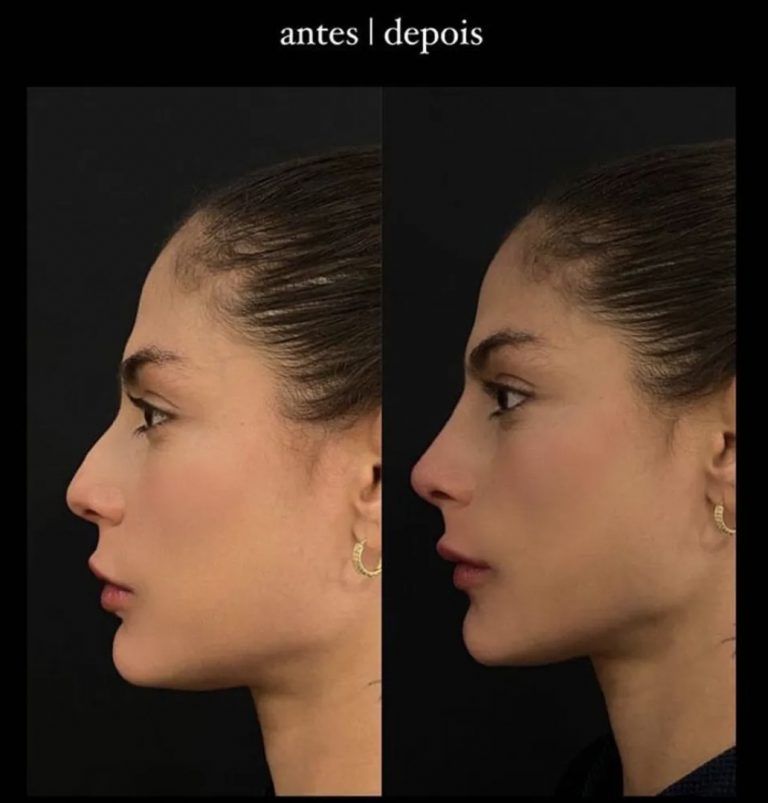 Mari Gonzalez mostra antes e depois de rinomodelação no nariz