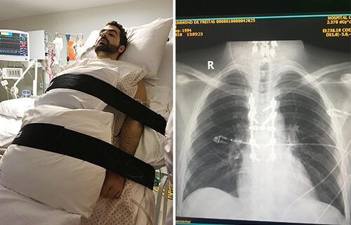 lesao-medula-interna5