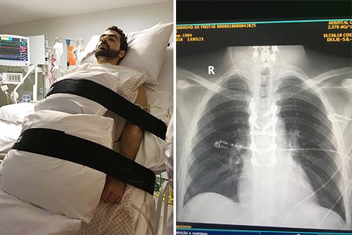 lesao-medula-interna5