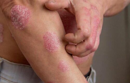 psoriase1_reproducao