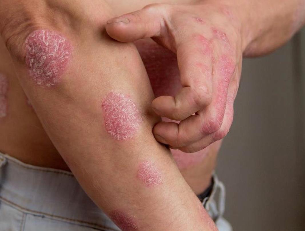 psoriase1_reproducao